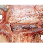 Photo INSERTIONS DE LA DURE-MERE SUR LE RACHIS Une anatomie redécouverte 14