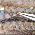 Photo INSERTIONS DE LA DURE-MERE SUR LE RACHIS Une anatomie redécouverte 14