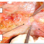 Photo INSERTIONS DE LA DURE-MERE SUR LE RACHIS Une anatomie redécouverte 19