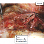 Photo INSERTIONS DE LA DURE-MERE SUR LE RACHIS Une anatomie redécouverte 22