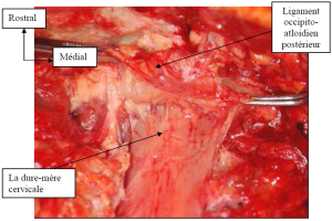 Photo INSERTIONS DE LA DURE-MERE SUR LE RACHIS Une anatomie redécouverte 24