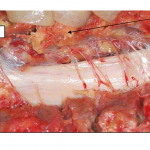 Photo INSERTIONS DE LA DURE-MERE SUR LE RACHIS Une anatomie redécouverte 28