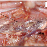 Photo INSERTIONS DE LA DURE-MERE SUR LE RACHIS Une anatomie redécouverte 6