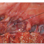 Photo INSERTIONS DE LA DURE-MERE SUR LE RACHIS Une anatomie redécouverte 8