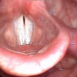 Vidéo de l’examen ORL « stroboscopie » de l’affrontement normale des plis vocaux'