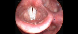 Vidéo de l’examen ORL « stroboscopie » de l’affrontement normale des plis vocaux'